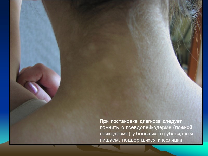 При постановке диагноза следует помнить о псевдолейкодерме (ложной лейкодерме) у больных отрубевидным лишаем, подвергшихся